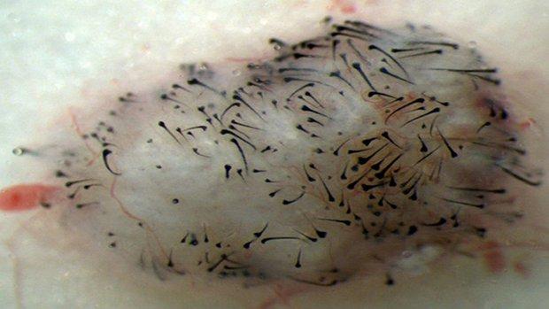 Using induced pluripotent stem cells to grow new hair Using induced pluripotent stem cells to grow new hair